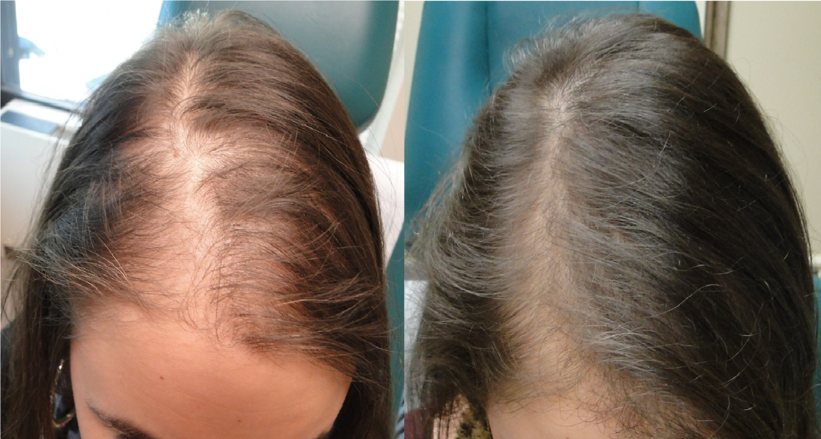 Example of hair loss treatment (before and after)