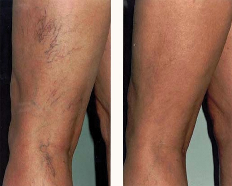 Example of red veins and facial thread veins treatment (before and after)
