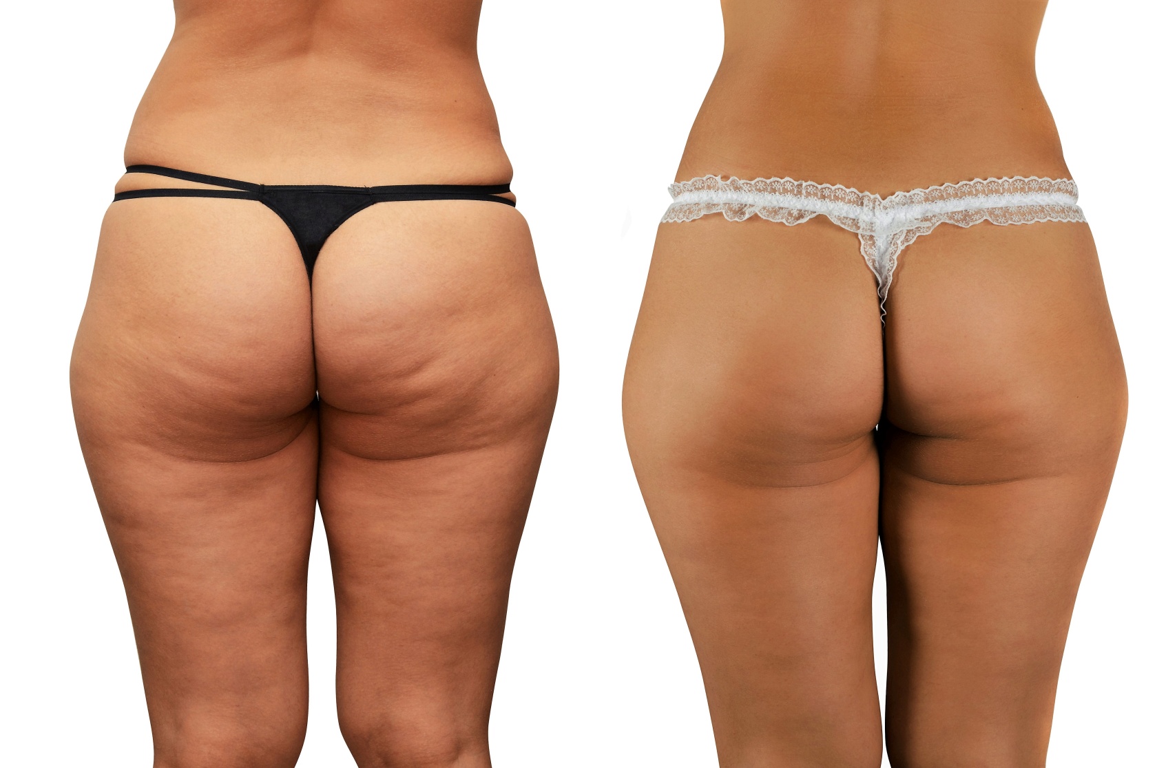 Example of cellulite treatment (before and after)
