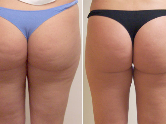 Example of cellulite treatment (before and after)
