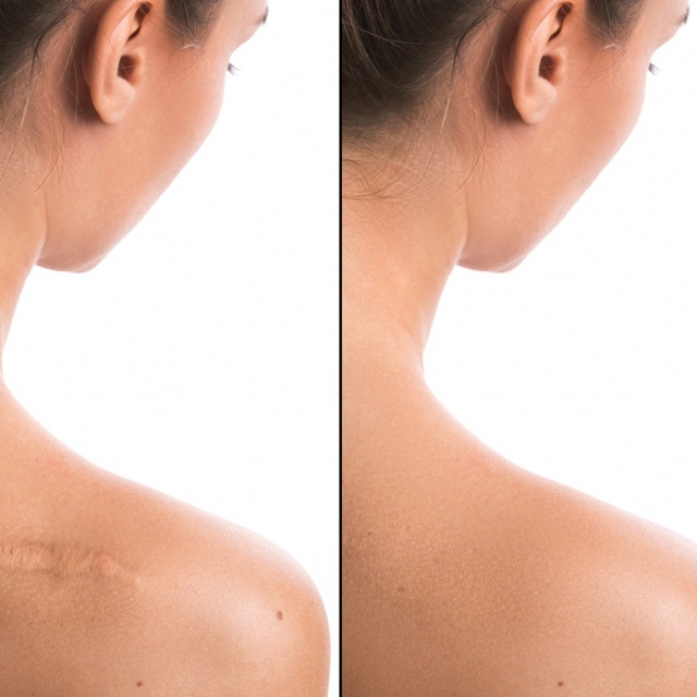 Scars and stretchmarks treatment