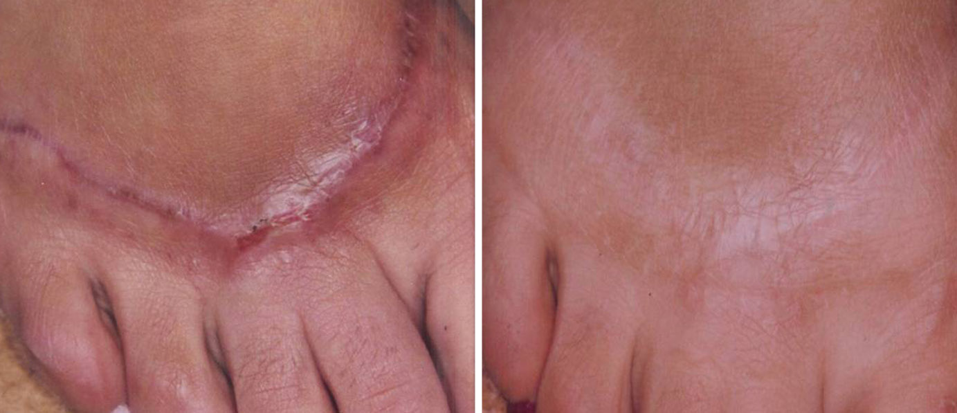 Example of scars and stretchmarks treatment (before and after)