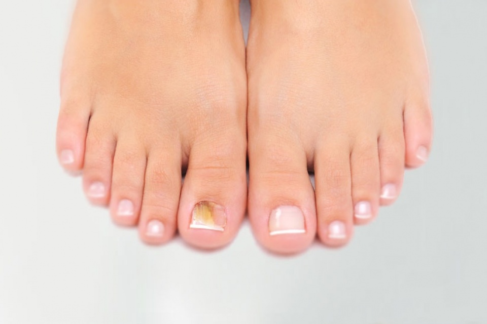 Nail fungus treatment