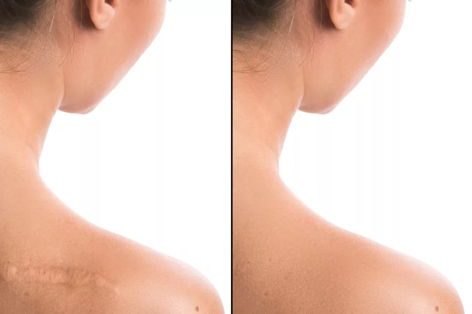 Scars and stretchmarks treatment Scars and stretchmarks treatment