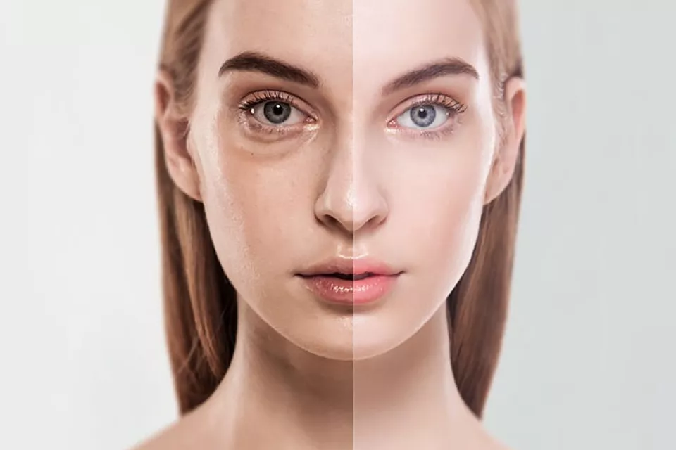 Ringe unter den Augen entfernen Ringe unter den Augen entfernen