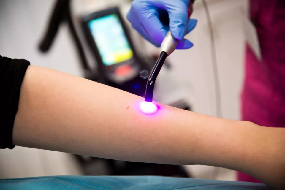 Laser treatment Laser treatment