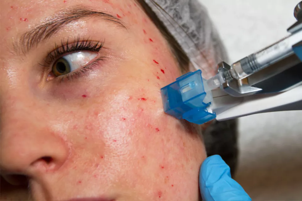 Mesotherapy Mesotherapy