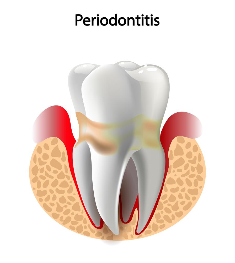 Periodontitis treatment