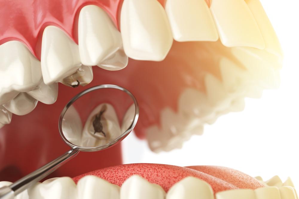 Dental caries treatment