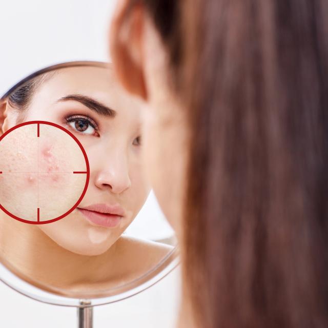 Acne treatment